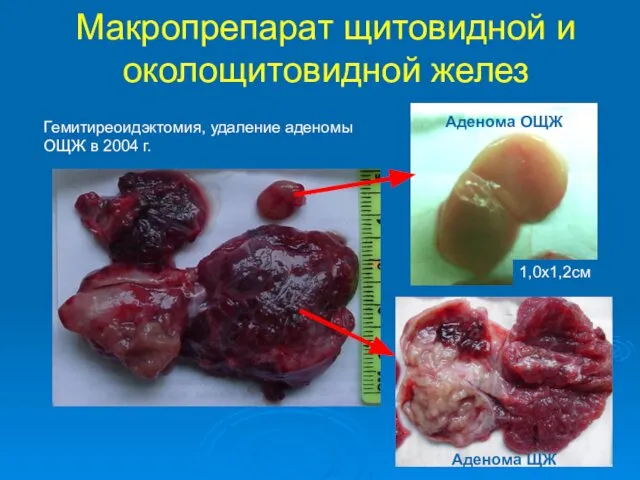 Макропрепарат щитовидной и околощитовидной желез 1,0х1,2см Аденома ОЩЖ Аденома ЩЖ Гемитиреоидэктомия,