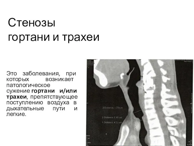 Стенозы гортани и трахеи Это заболевания, при которых возникает патологическое сужение