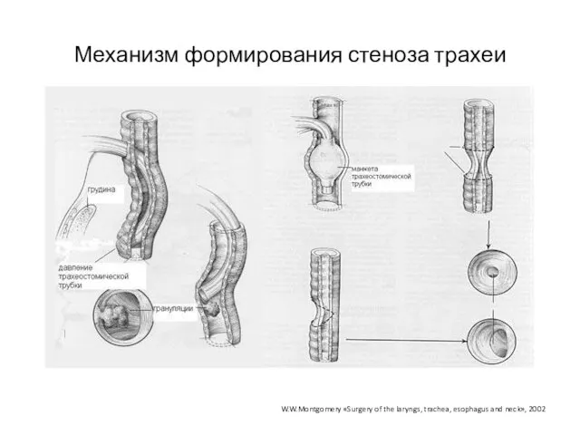 Механизм формирования стеноза трахеи W.W.Montgomery «Surgery of the laryngs, trachea, esophagus and neck», 2002