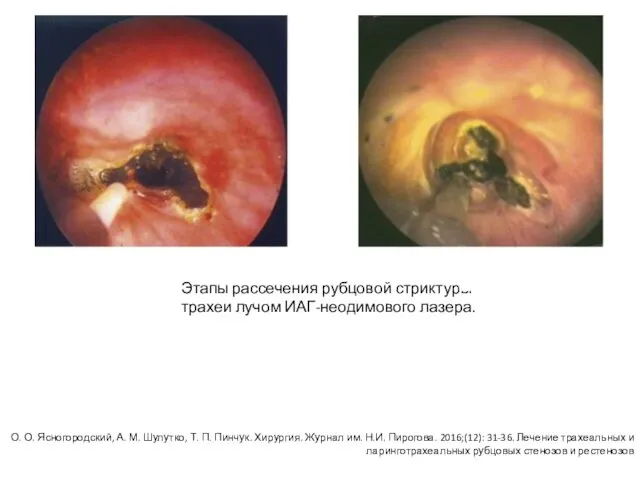 Этапы рассечения рубцовой стриктуры трахеи лучом ИАГ-неодимового лазера. О. О. Ясногородский,