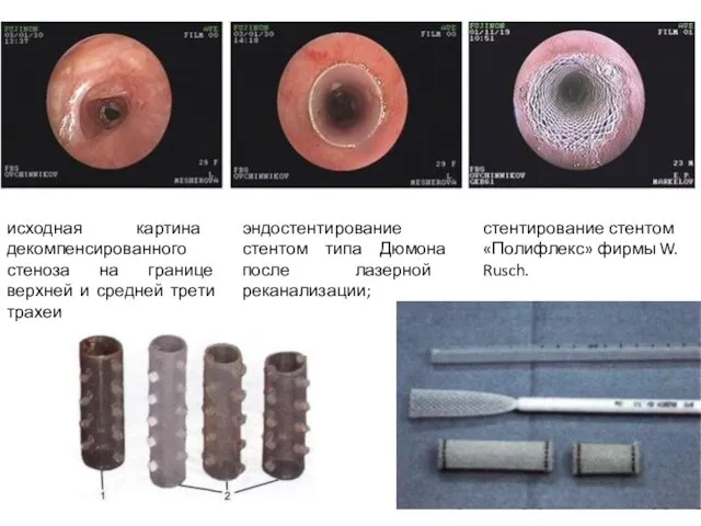 исходная картина декомпенсированного стеноза на границе верхней и средней трети трахеи