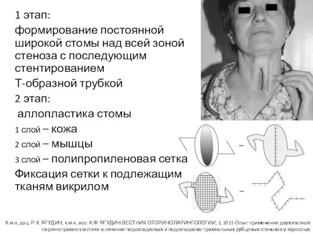 1 этап: формирование постоянной широкой стомы над всей зоной стеноза с