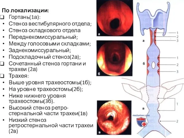 По локализации: Гортань(1а): Стеноз вестибулярного отдела; Стеноз складкового отдела Переднекомиссуральный; Между