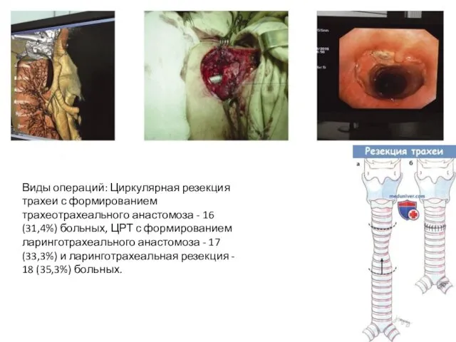 Виды операций: Циркулярная резекция трахеи с формированием трахеотрахеального анастомоза - 16