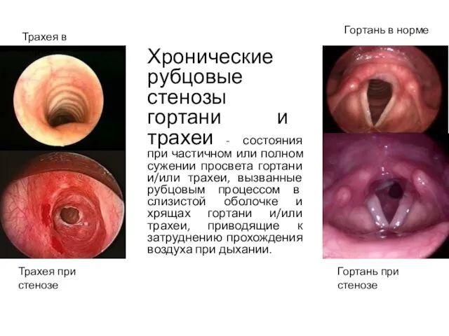 Хронические рубцовые стенозы гортани и трахеи - состояния при частичном или