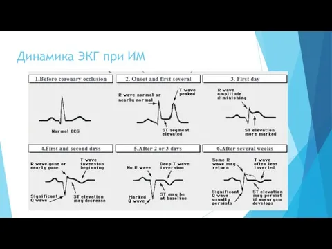 Динамика ЭКГ при ИМ