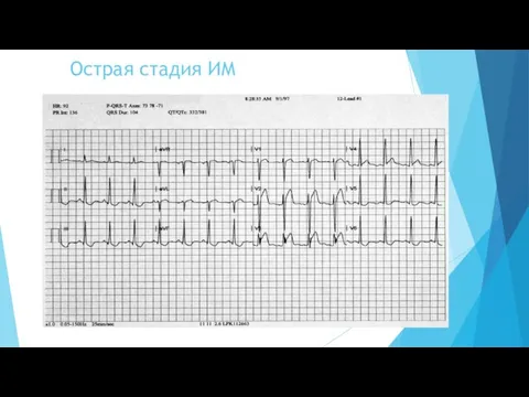 Острая стадия ИМ