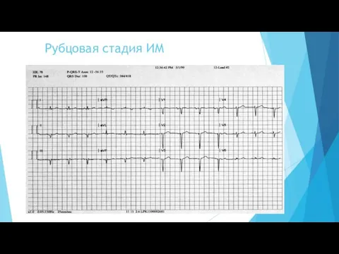 Рубцовая стадия ИМ