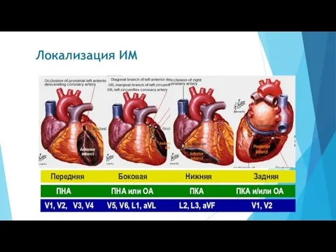 Локализация ИМ Передняя Боковая Нижняя Задняя ПНА ПНА или ОА ПКА