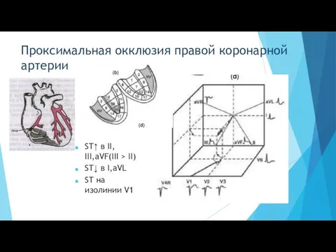 Проксимальная окклюзия правой коронарной артерии ST↑ в II, III,aVF(III > II)