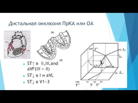 Дистальная окклюзия ПрКА или ОА ST↑ в II,III,and aVF(III > II)