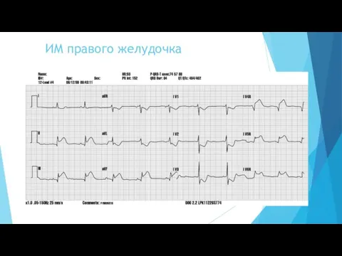 ИМ правого желудочка