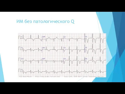 ИМ без патологического Q