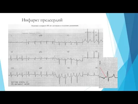 Инфаркт предсердий