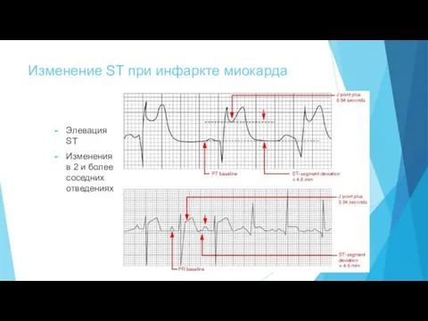 Изменение ST при инфаркте миокарда Элевация ST Изменения в 2 и более соседних отведениях