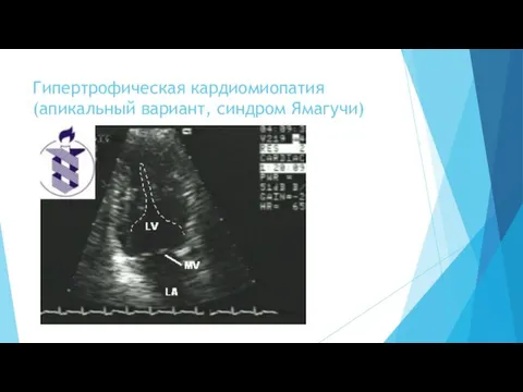 Гипертрофическая кардиомиопатия (апикальный вариант, синдром Ямагучи)