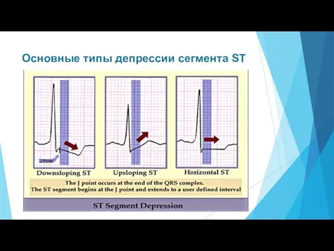 Основные типы депрессии сегмента ST