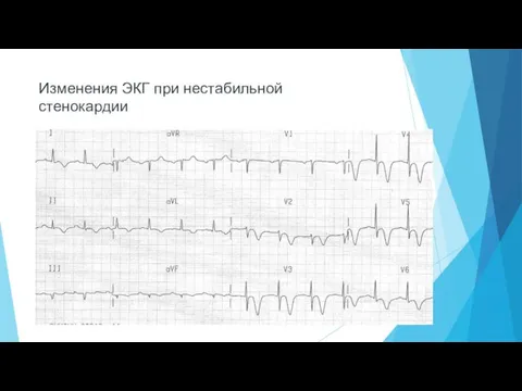 Изменения ЭКГ при нестабильной стенокардии