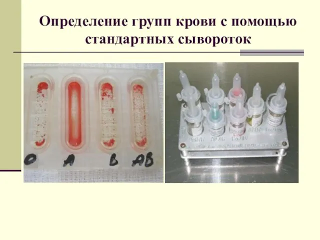 Определение групп крови с помощью стандартных сывороток