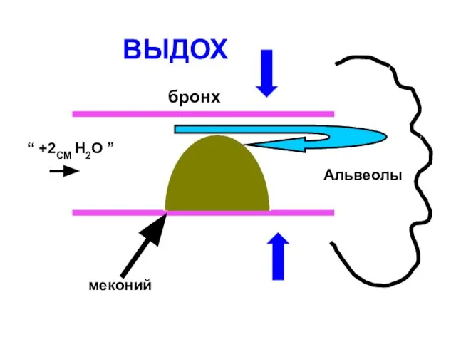 бронх Альвеолы меконий “ +2СМ Н2О ” ВЫДОХ