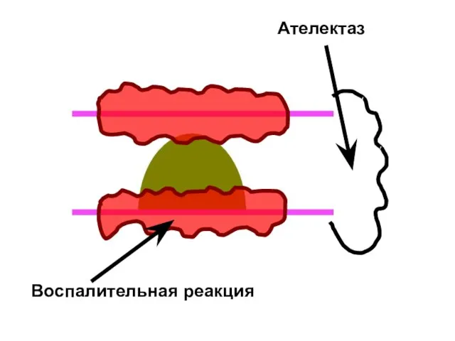 Воспалительная реакция Ателектаз