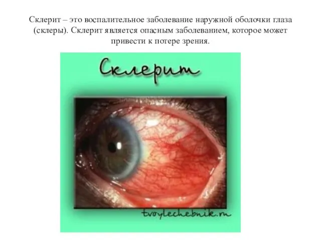 Склерит – это воспалительное заболевание наружной оболочки глаза (склеры). Склерит является