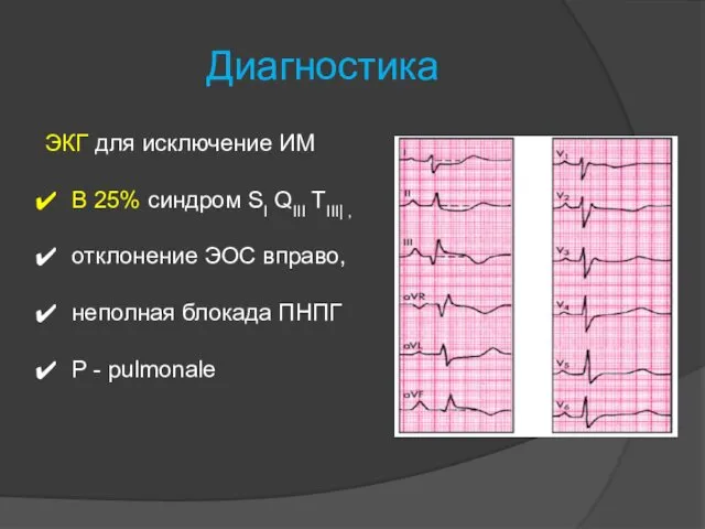 Диагностика ЭКГ для исключение ИМ В 25% синдром SI QIII TIII|