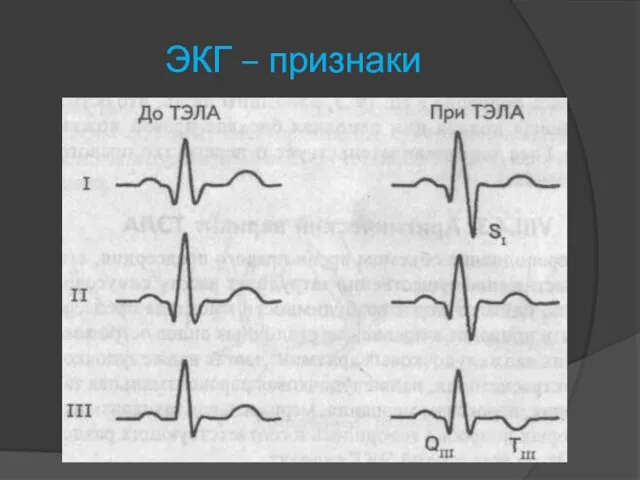 ЭКГ – признаки