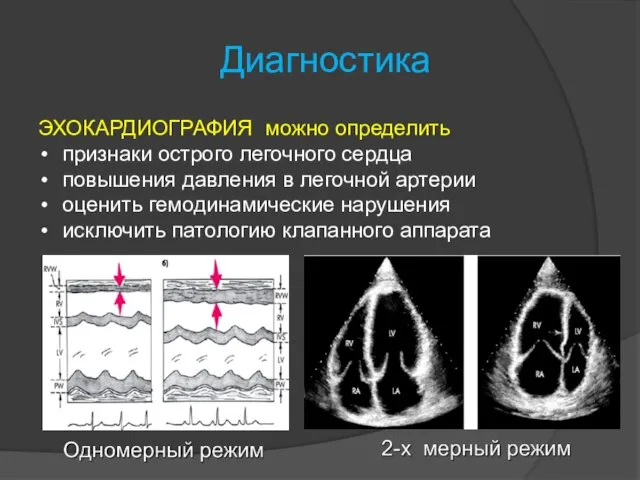 Диагностика ЭХОКАРДИОГРАФИЯ можно определить признаки острого легочного сердца повышения давления в