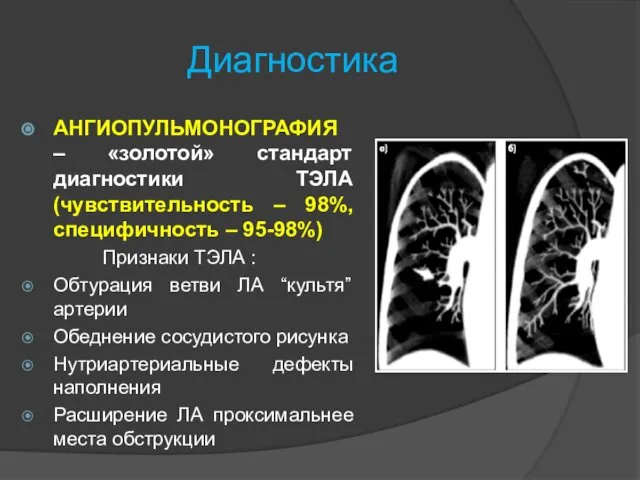 Диагностика АНГИОПУЛЬМОНОГРАФИЯ – «золотой» стандарт диагностики ТЭЛА (чувствительность – 98%, специфичность