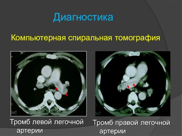 Диагностика Компьютерная спиральная томография