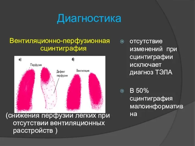 Диагностика Вентиляционно-перфузионная сцинтиграфия (снижения перфузии легких при отсутствии вентиляционных расстройств )