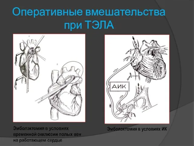 Оперативные вмешательства при ТЭЛА