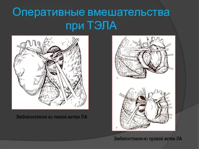 Оперативные вмешательства при ТЭЛА