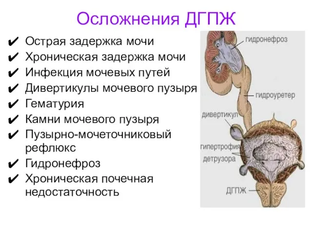 Осложнения ДГПЖ Острая задержка мочи Хроническая задержка мочи Инфекция мочевых путей