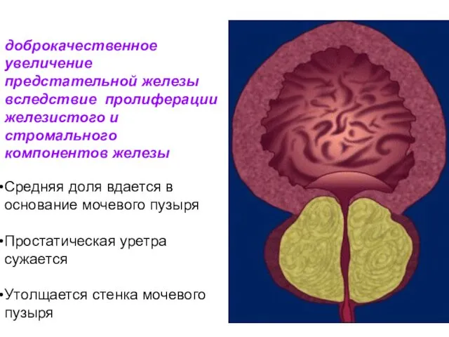 доброкачественное увеличение предстательной железы вследствие пролиферации железистого и стромального компонентов железы