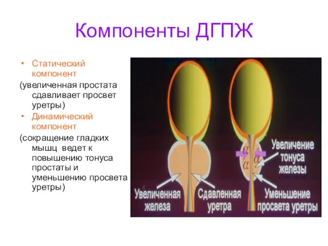 Компоненты ДГПЖ Статический компонент (увеличенная простата сдавливает просвет уретры) Динамический компонент