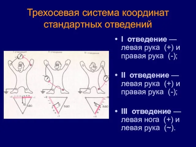 Трехосевая система координат стандартных отведений I отведение — левая рука (+)