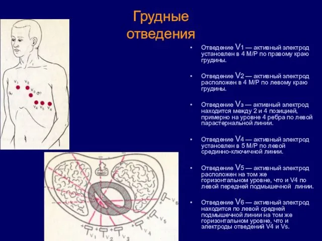 Грудные отведения Отведение V1 — активный электрод установлен в 4 М/Р