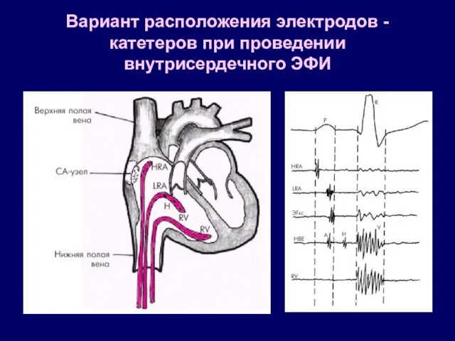 Вариант расположения электродов - катетеров при проведении внутрисердечного ЭФИ