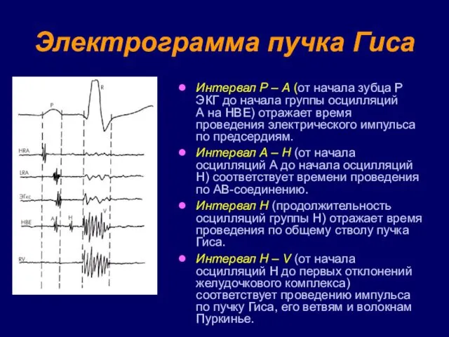 Электрограмма пучка Гиса Интервал Р – А (от начала зубца Р