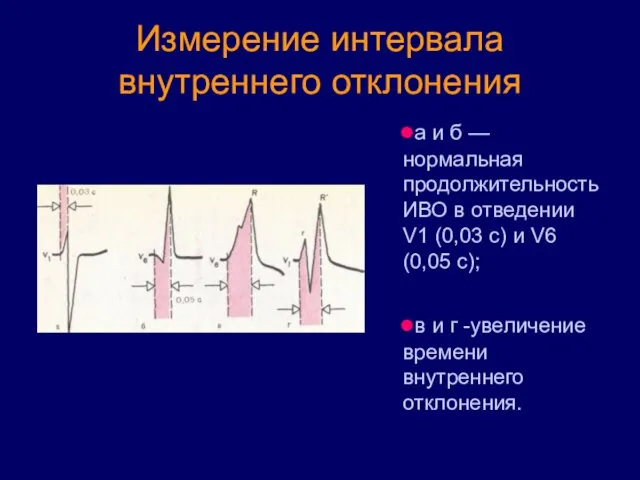 Измерение интервала внутреннего отклонения а и б — нормальная продолжительность ИВО