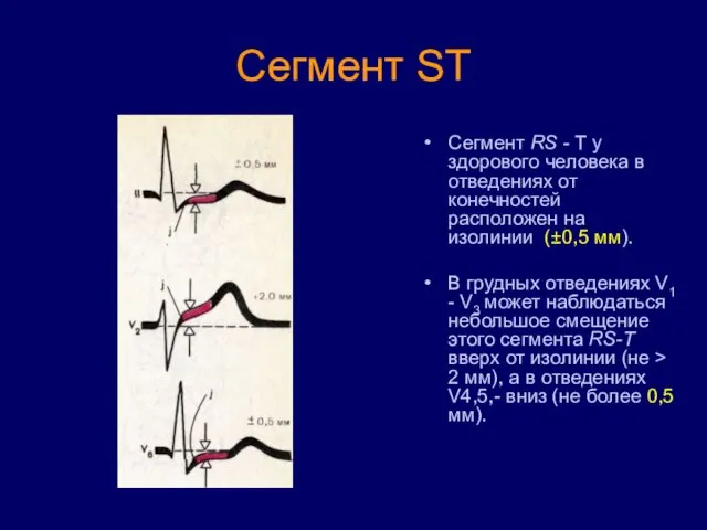 Сегмент ST Сегмент RS - Т у здорового человека в отведениях