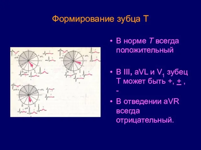 Формирование зубца Т В норме Т всегда положительный В III, aVL