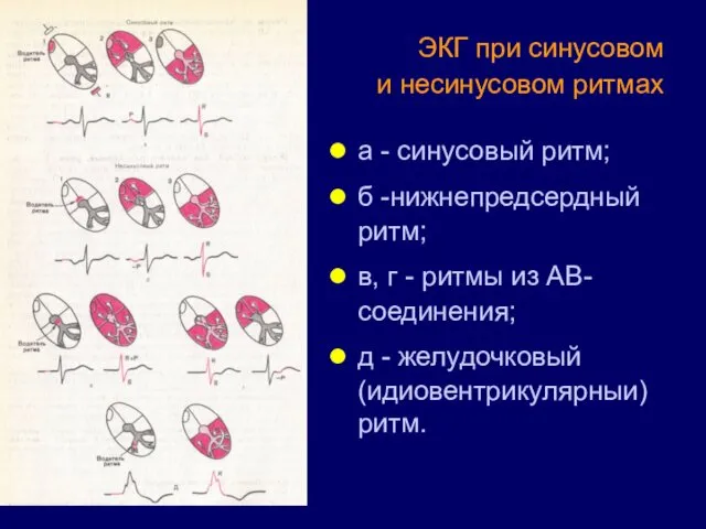 ЭКГ при синусовом и несинусовом ритмах а - синусовый ритм; б