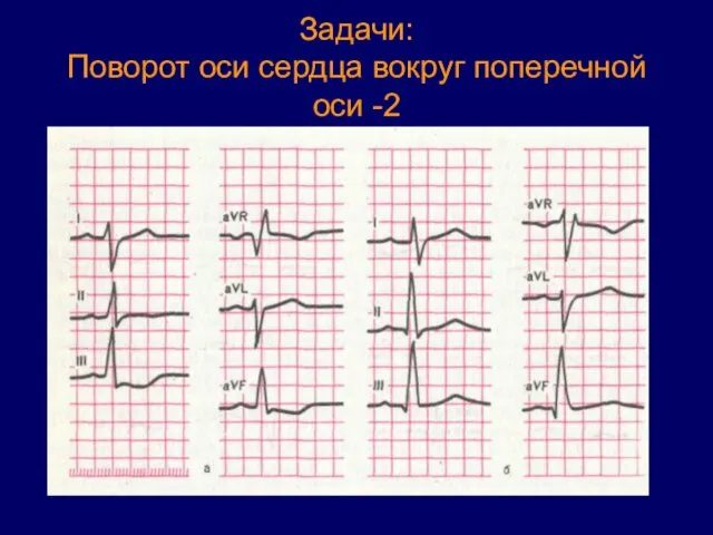 Задачи: Поворот оси сердца вокруг поперечной оси -2