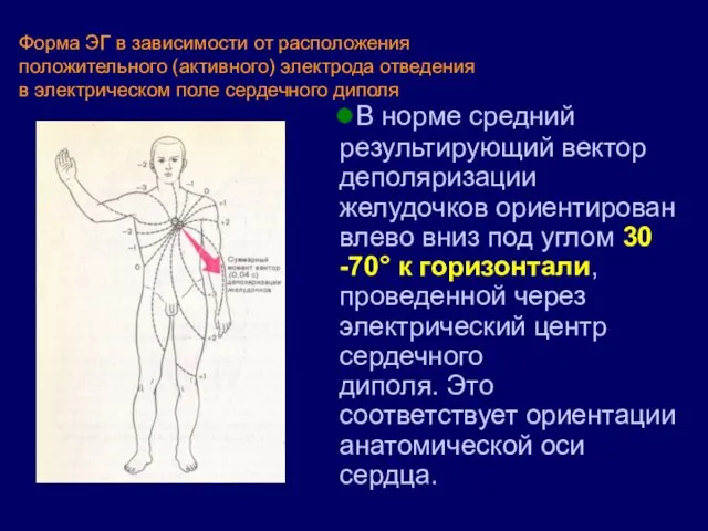 Форма ЭГ в зависимости от расположения положительного (активного) электрода отведения в