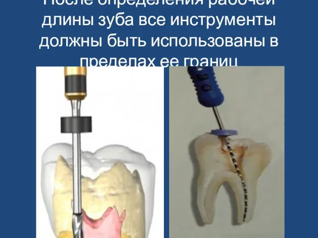 После определения рабочей длины зуба все инструменты должны быть использованы в пределах ее границ