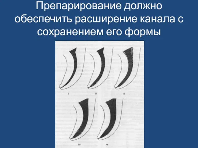 Препарирование должно обеспечить расширение канала с сохранением его формы