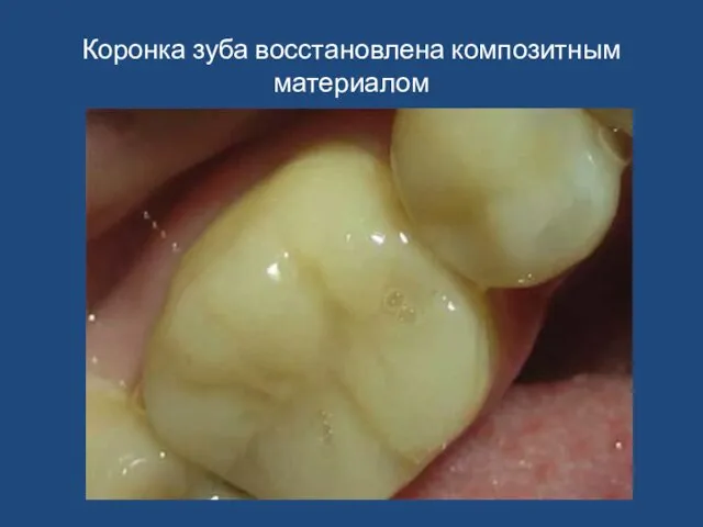 Коронка зуба восстановлена композитным материалом